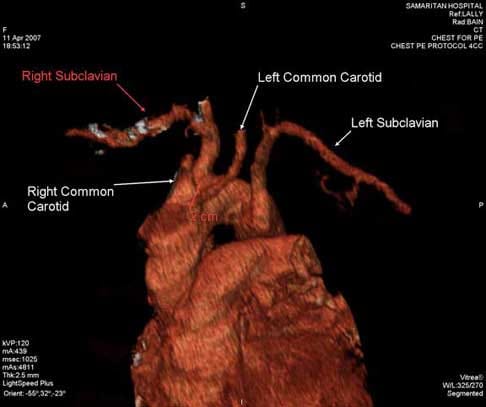 Aortic Arch Reconstruction 1