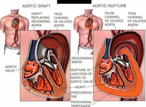 Aortic Graft Rupture