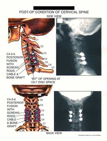 Cervical Spine Injury