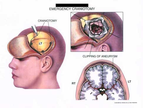 Emergency Craniotomy