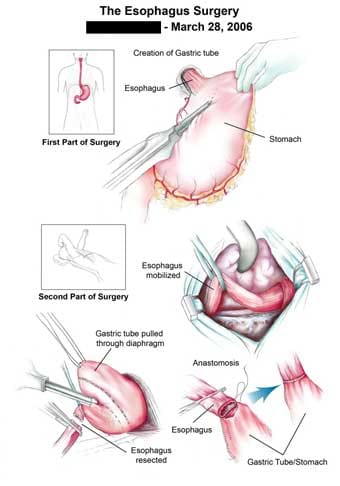 Esophagus Surgery Storyboard Before and After