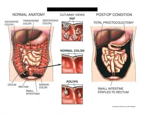 Proctocolectomy Post Op