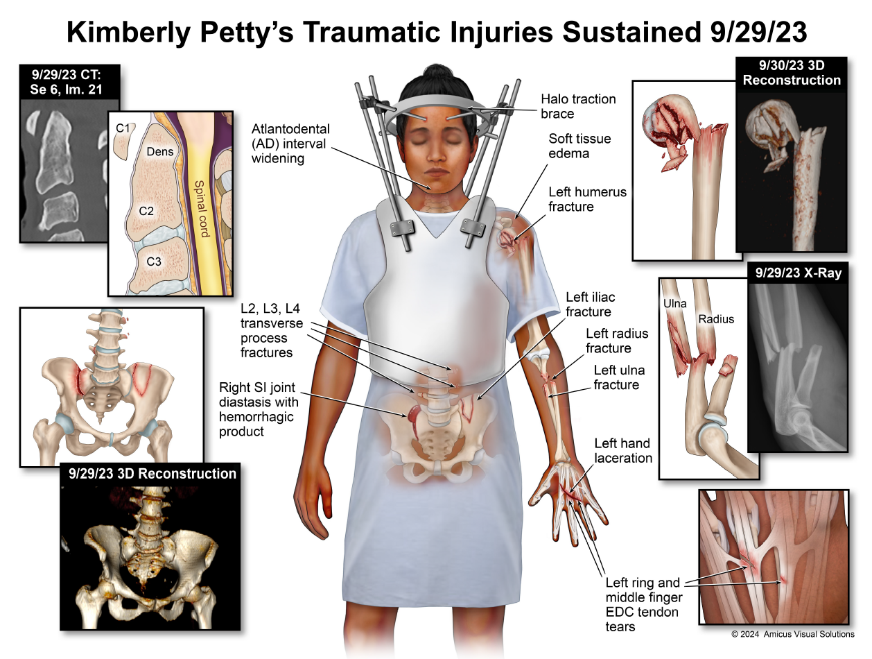 Kimberly Petty's Traumatic Injuries Sustained 9/29/23