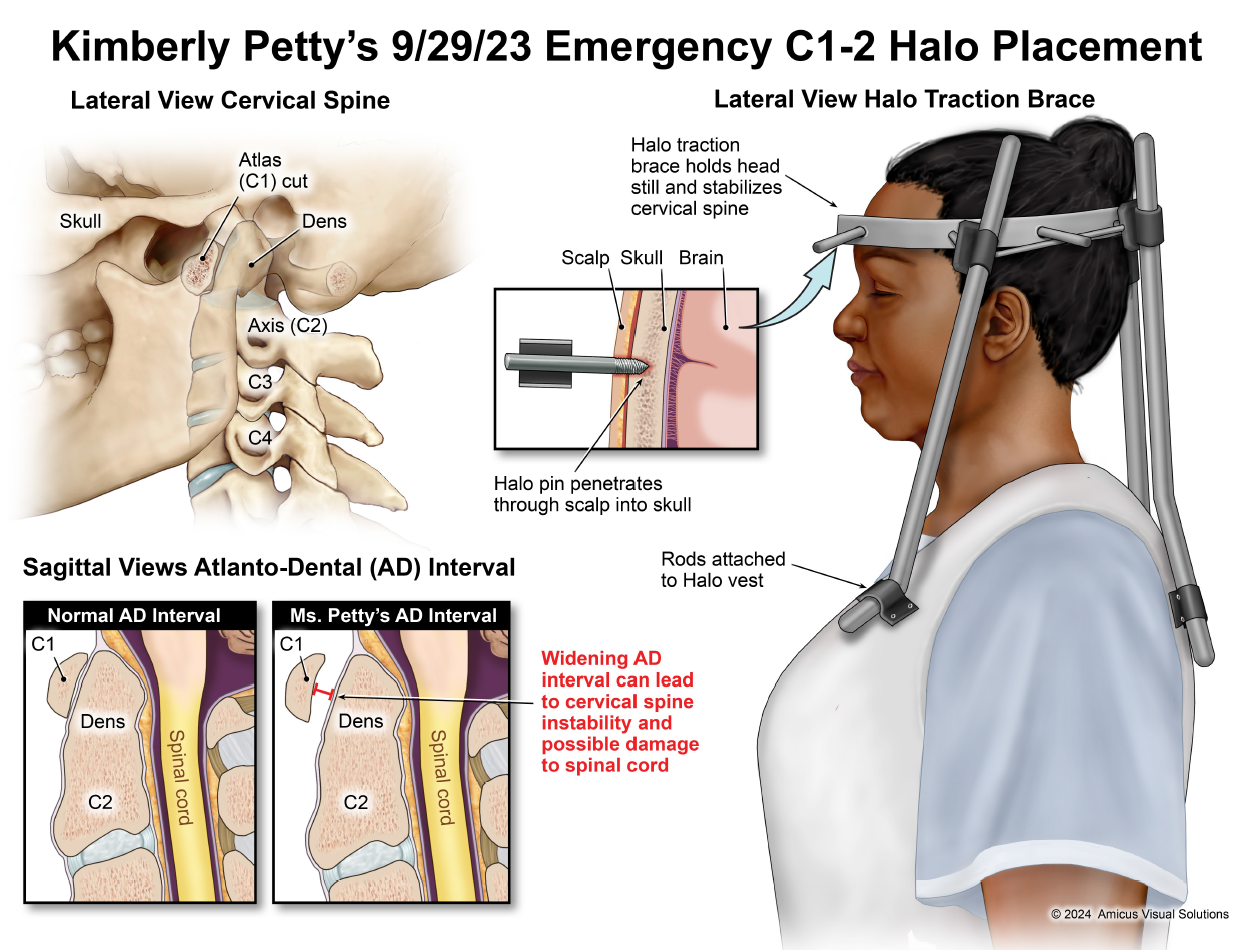 Kimberly Petty's 9/29/23 Emergency C1-2 Halo Placement