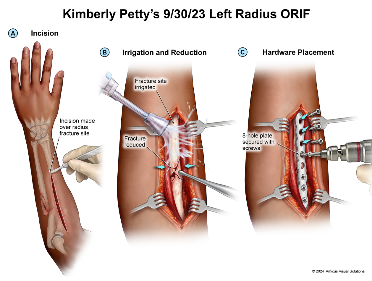 Kimberly Petty's 9/30/23 Left Radius ORIF