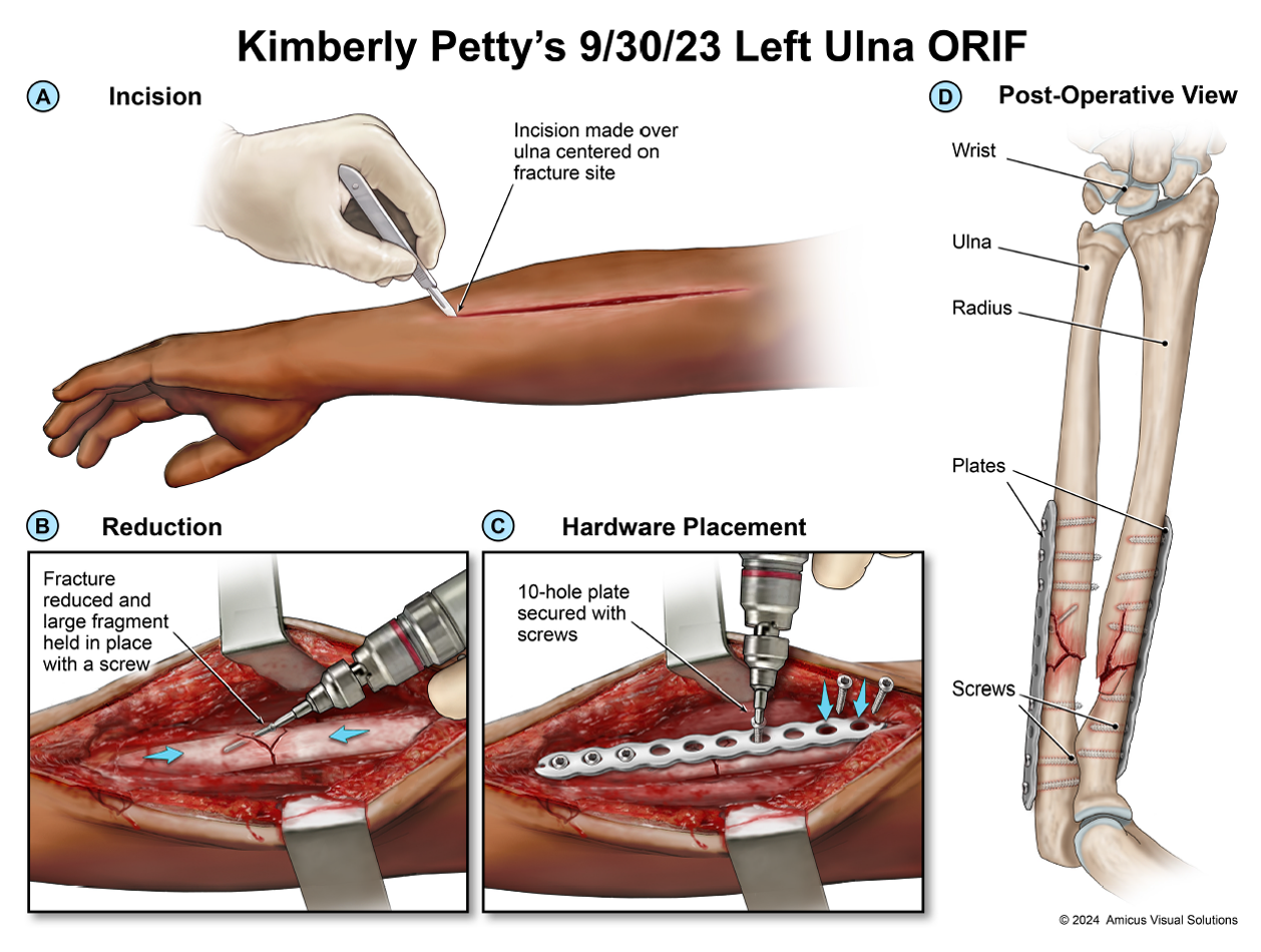 Kimberly Petty's 9/30/23 Left Ulna ORIF