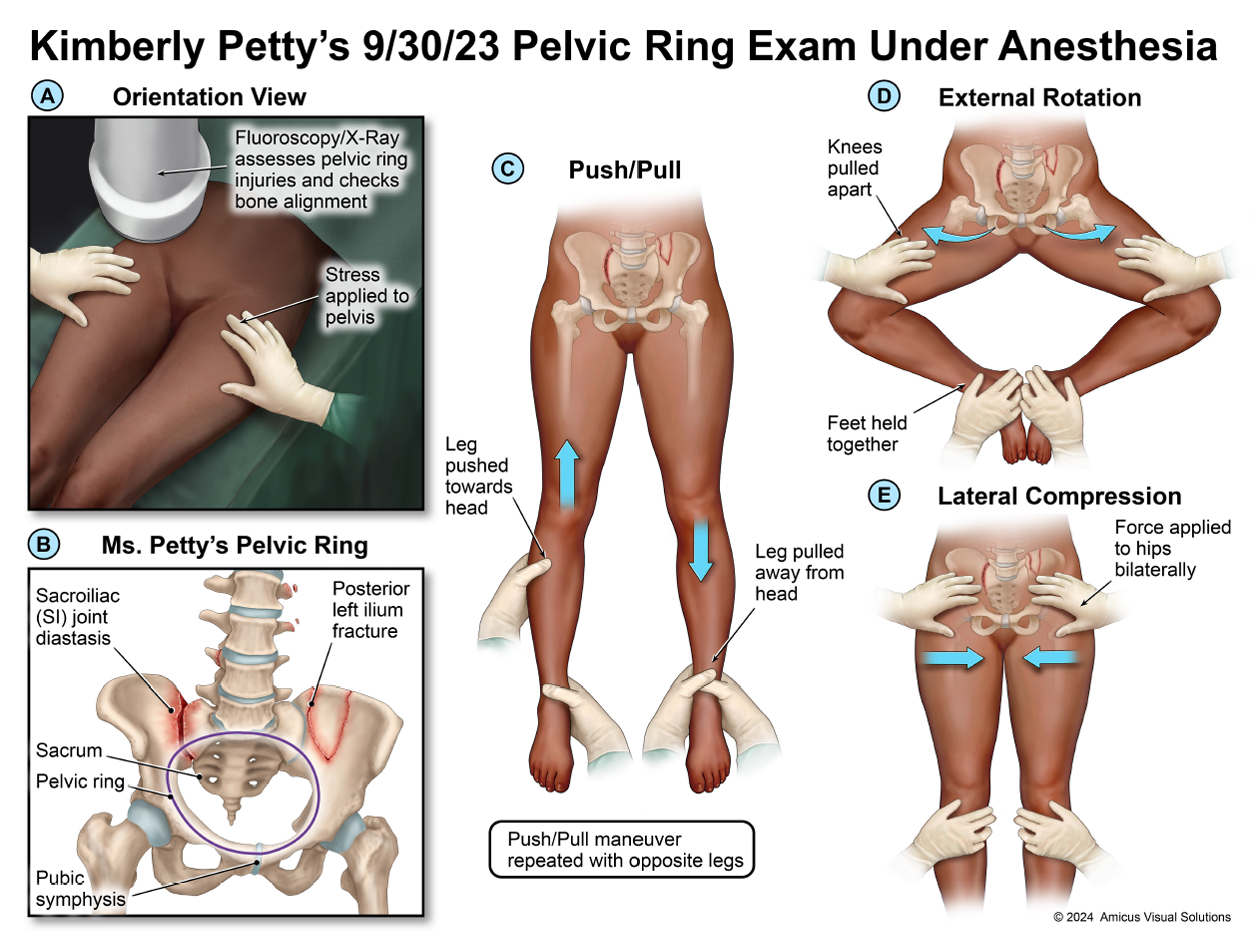 Kimberly Petty's 9/30/23 Pelvic Ring Exam Under Anesthesia