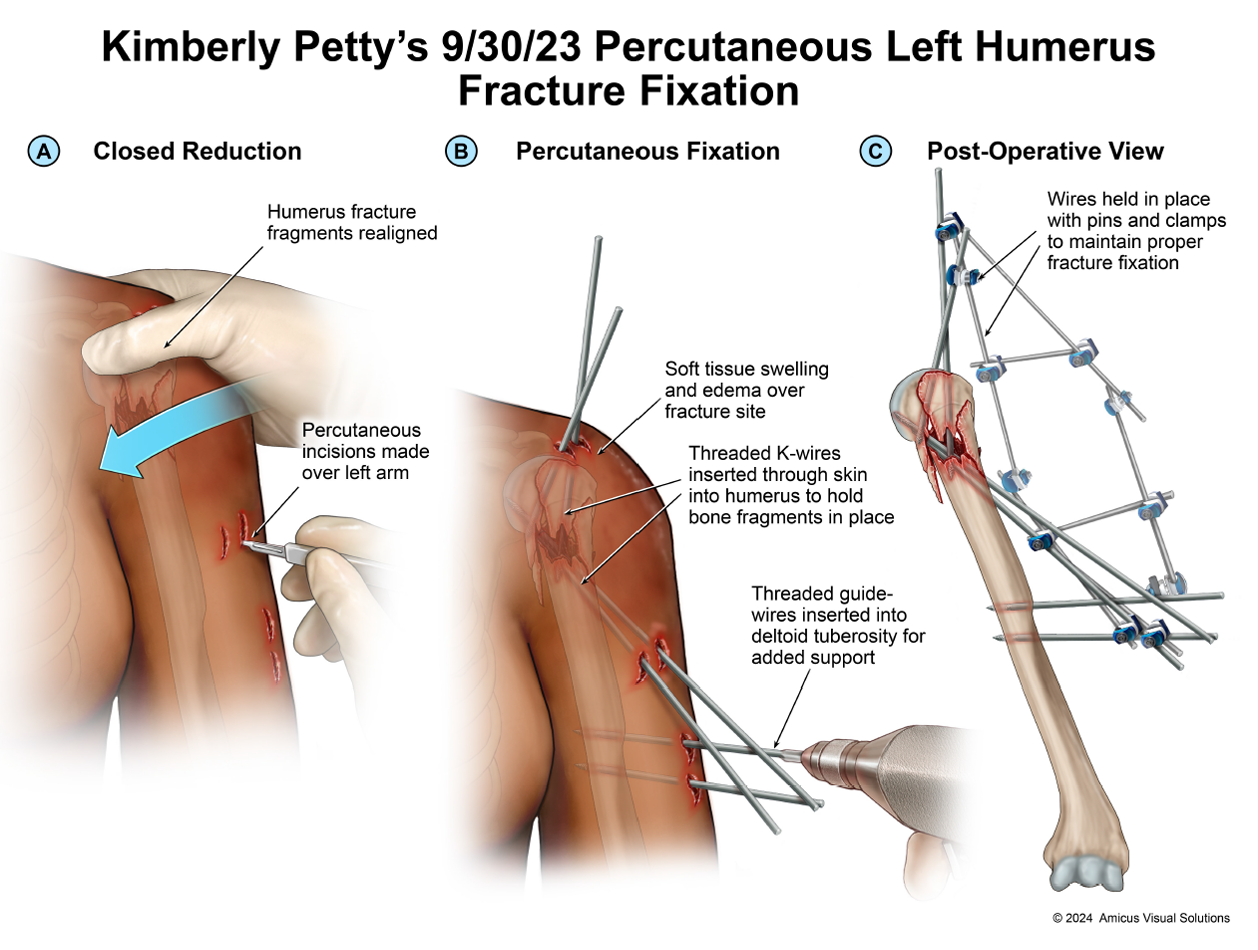 Kimberly Petty's 9/30/23 Percutaneous Left Humerus Fracture Fixation