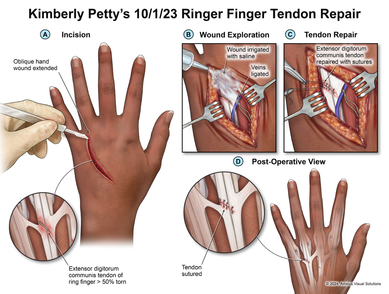Kimberly Petty's 10/1/23 Ringer Finger Tendon Repair
