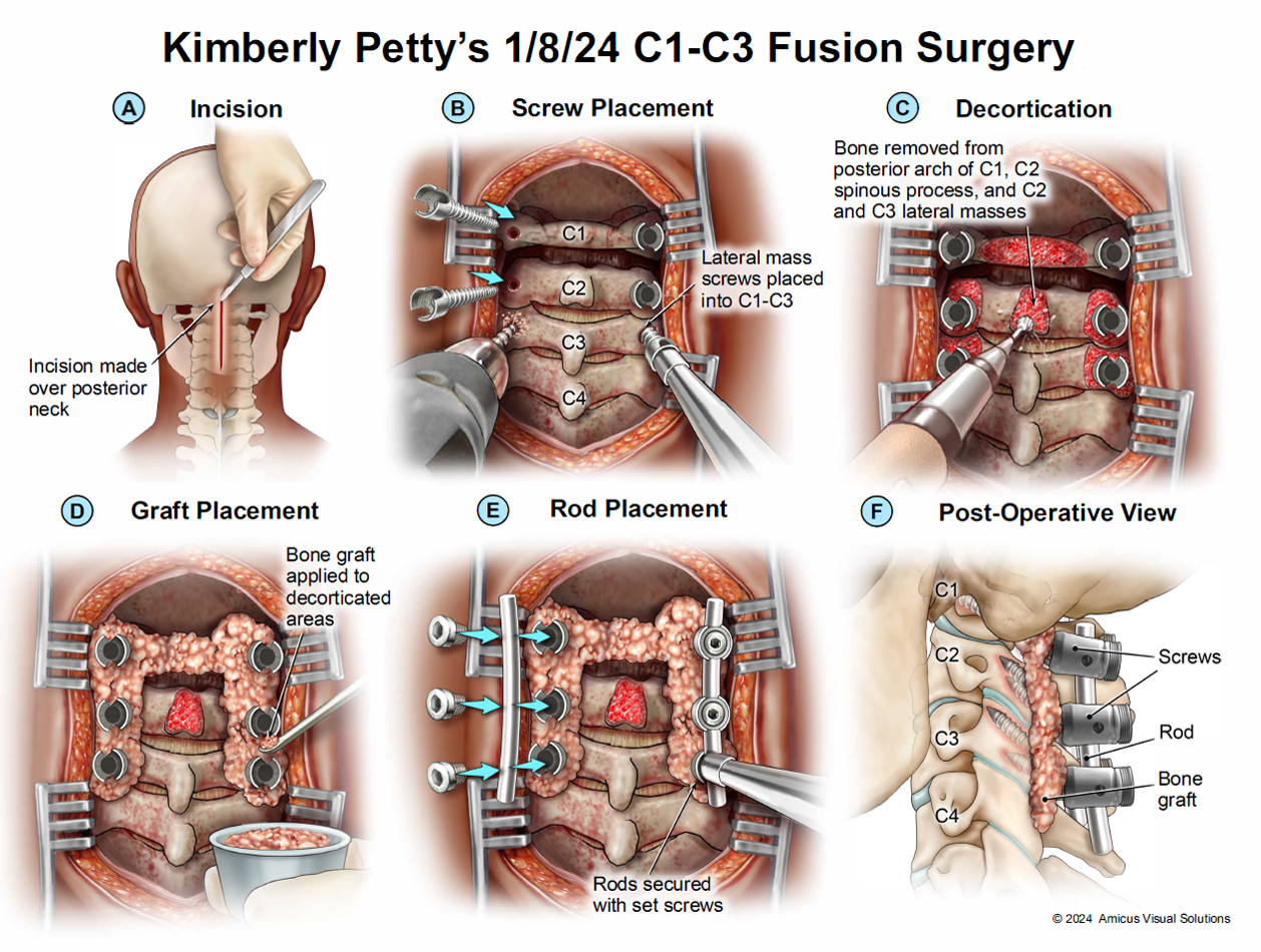 Kimberly Petty's 1/8/24 C1-C3 Fusion Surgery